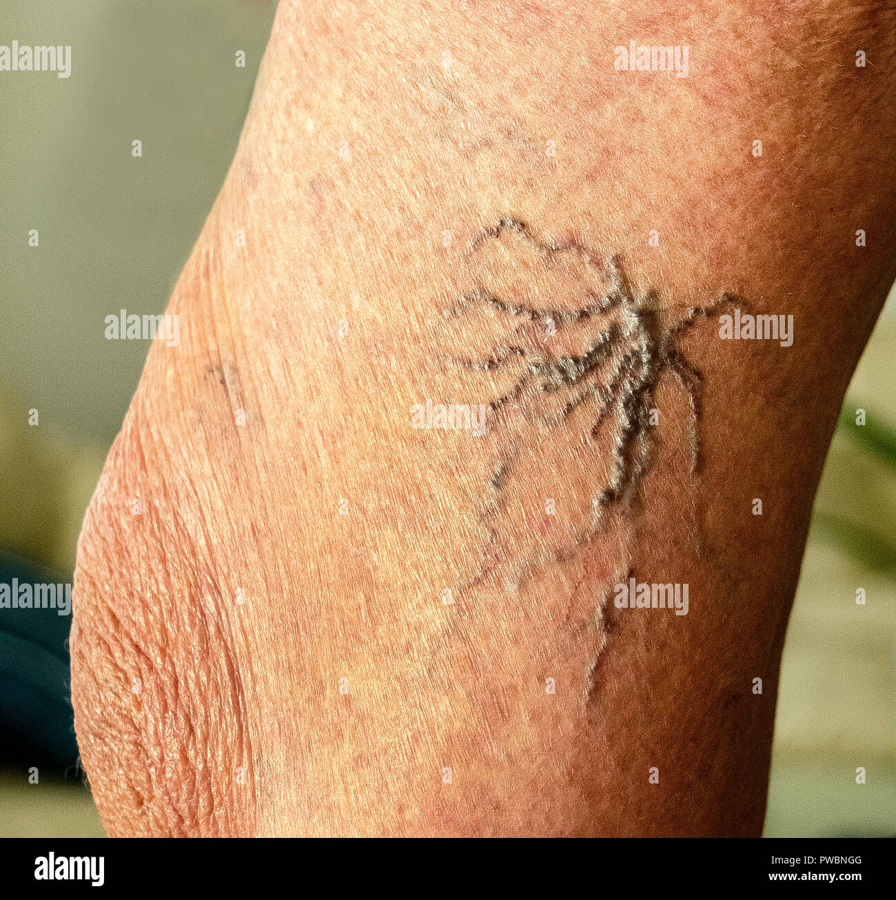 Bien-nommé varicosités afficher sous la peau à proximité du genou sur la jambe d'une femme de race blanche âgés. Les varicosités sont des versions plus petites de varices, qui sont des vaisseaux sanguins dilatés qui forment souvent dans les jambes. Elles se développent lorsque les soupapes et les parois des veines sont faibles et la cause du sang dans les veines. Certains médecins offrent le traitement que l'utilisation de produits chimiques ou de lasers pour rendre les varicosités s'atténuent ou disparaissent. Banque D'Images