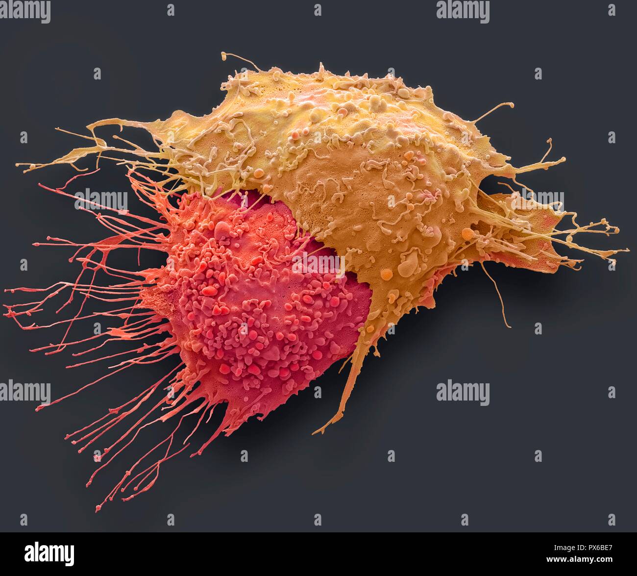 Les cellules du cancer de l'ovaire. Couleur de l'analyse des électrons Microphotographie (SEM) de cancer de l'ovaire des cellules. Les cellules cancéreuses sont généralement grandes, ont une surface irrégulière Banque D'Images