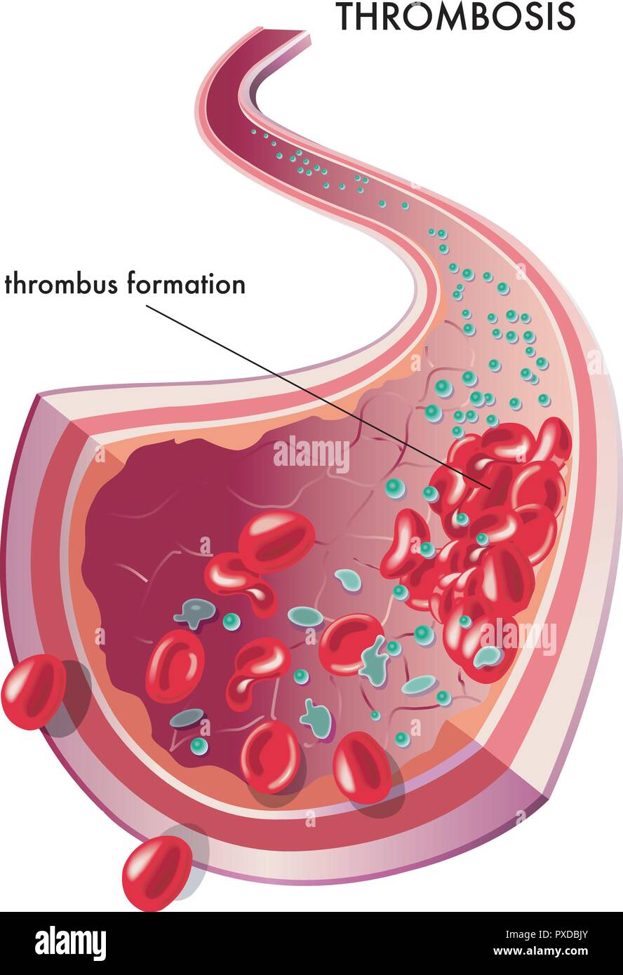Illustration médicale de la formation d'un thrombus Illustration de Vecteur