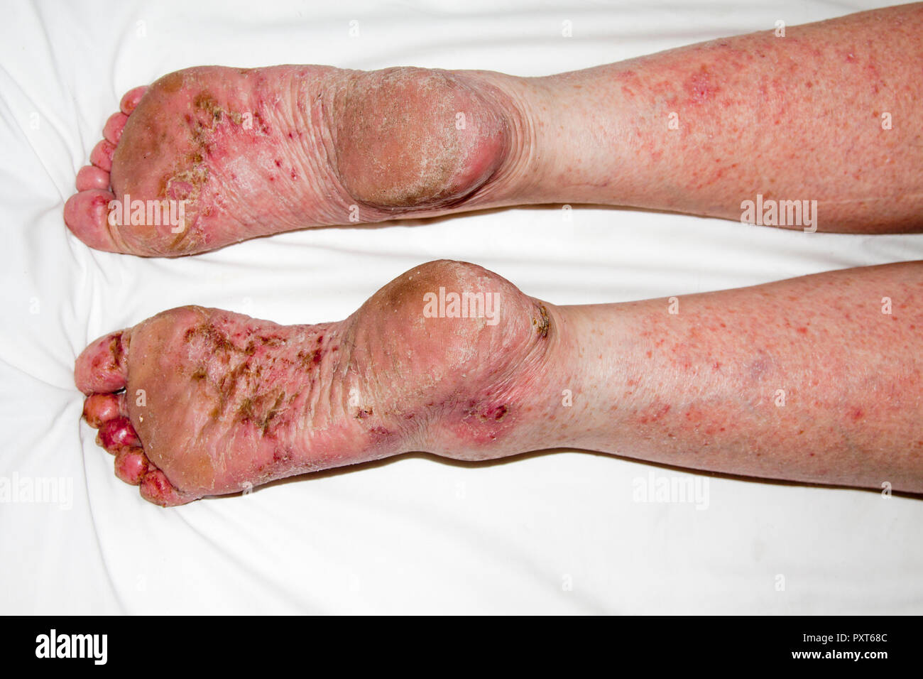 Patient avec la dermatite atopique ou eczéma endogène, Allemagne Banque D'Images