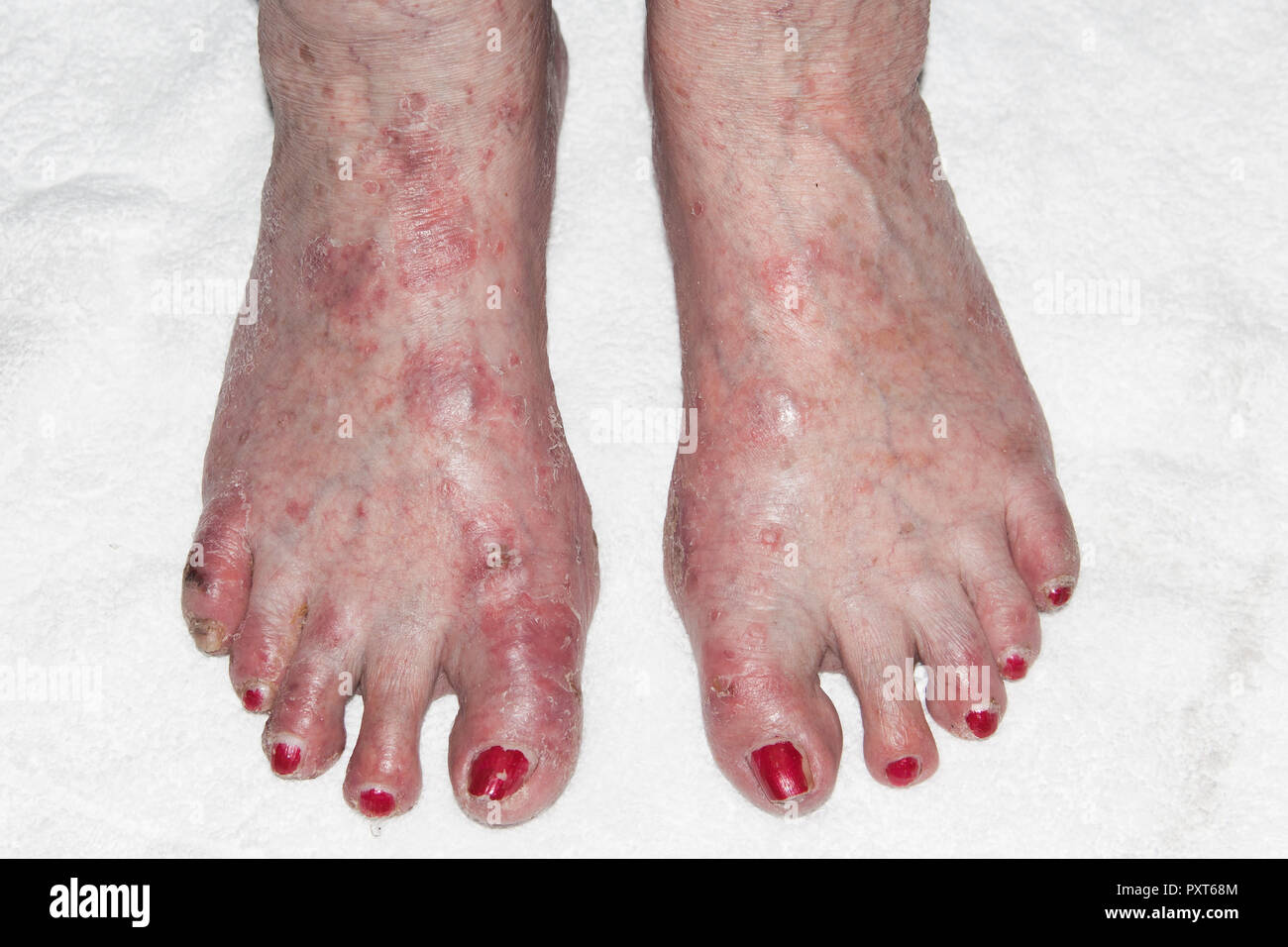 Patient avec la dermatite atopique ou eczéma endogène, Allemagne Banque D'Images