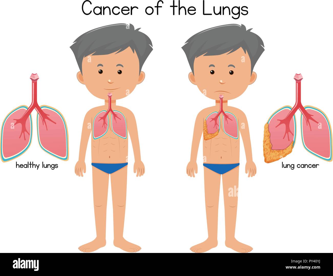 Le cancer des poumons illustration Illustration de Vecteur