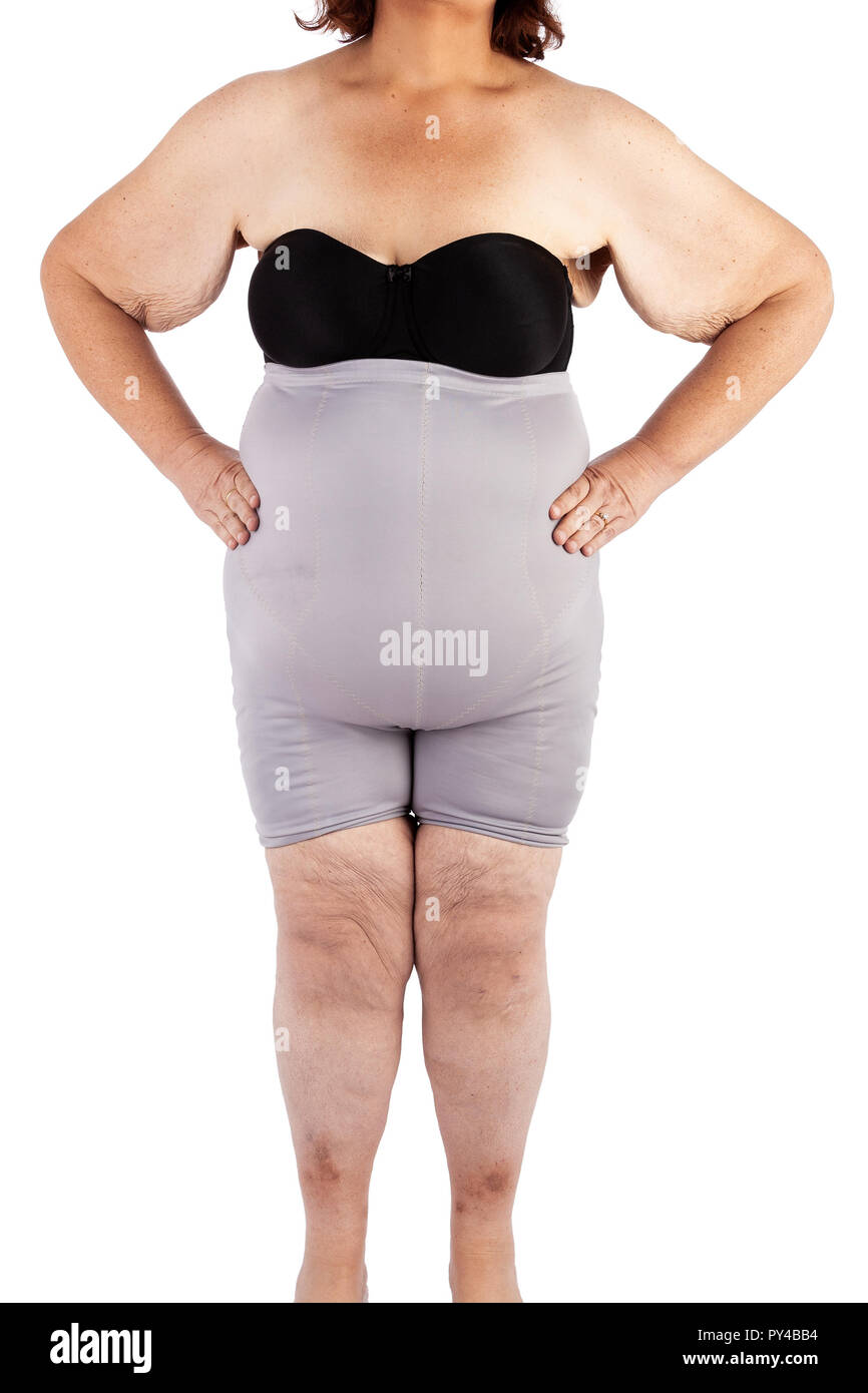 Femme d'âge moyen avec la peau flasque après perte extrême de poids Photo  Stock - Alamy