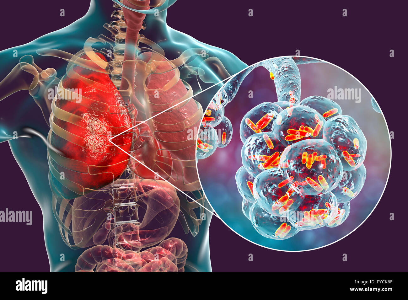 La pneumonie bactérienne. Illustration d'ordinateur de bactéries en forme de bâtonnet (bacilles) dans les alvéoles des poumons, causant une infection des voies respiratoires inférieures. C'est plus généralement connue sous le nom de pneumonie, si ce terme peut également être réservés pour des types spécifiques de l'infection. De graves infections pulmonaires sont diagnostiqués par X-ray et traitées par antibiotiques. Les alvéoles sont le site d'échanges gazeux entre l'air dans les poumons et dans le sang. Banque D'Images