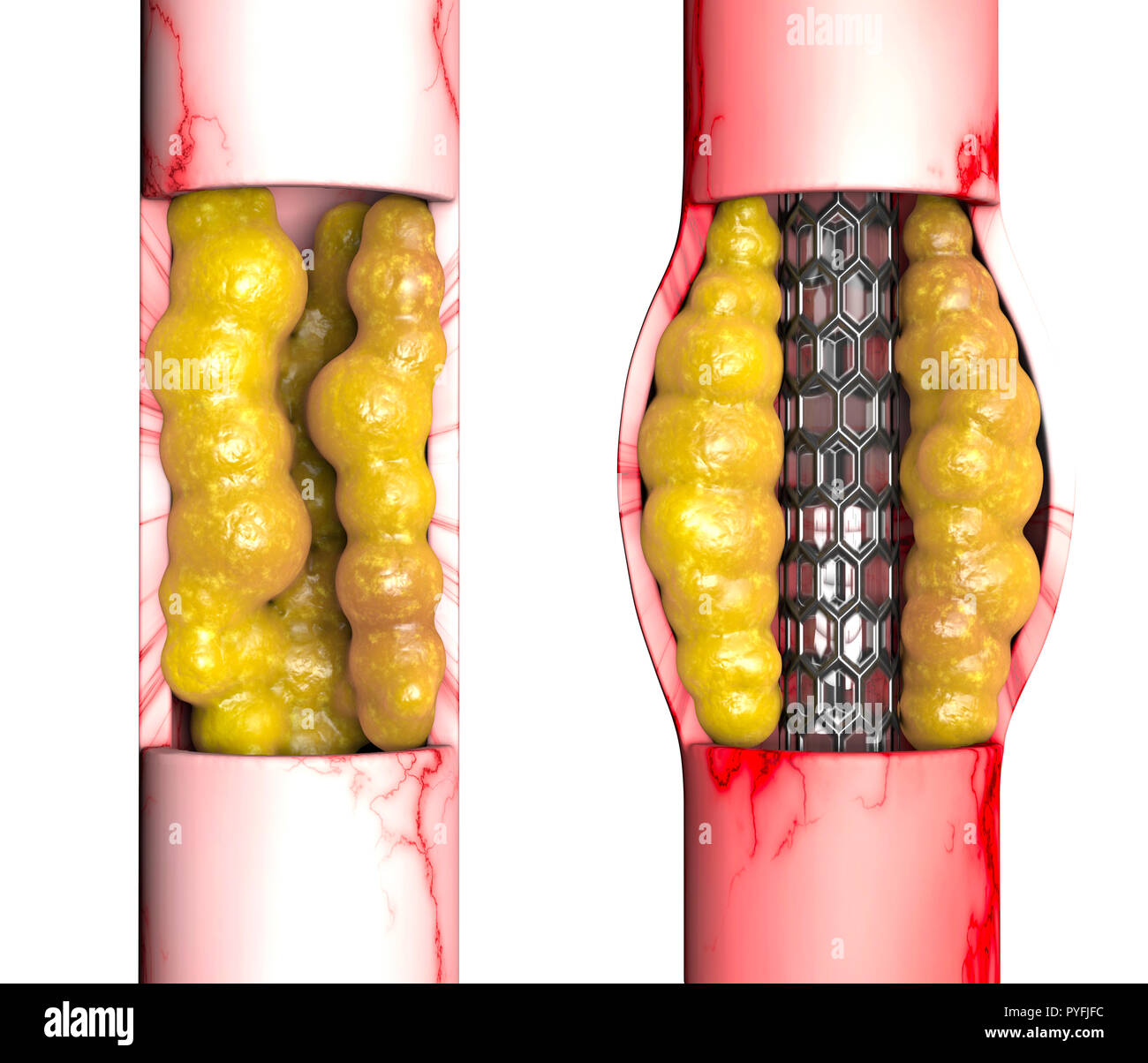 L'artère coronaire, est une procédure chirurgicale pour restaurer le flux sanguin normal à une artère coronaire obstruée. Cœur et l'attaque cardiaque Banque D'Images L'artère coronaire, est une procédure chirurgicale pour restaurer le flux sanguin normal à une artère coronaire obstruée. Cœur et l'attaque cardiaque Banque D'Images