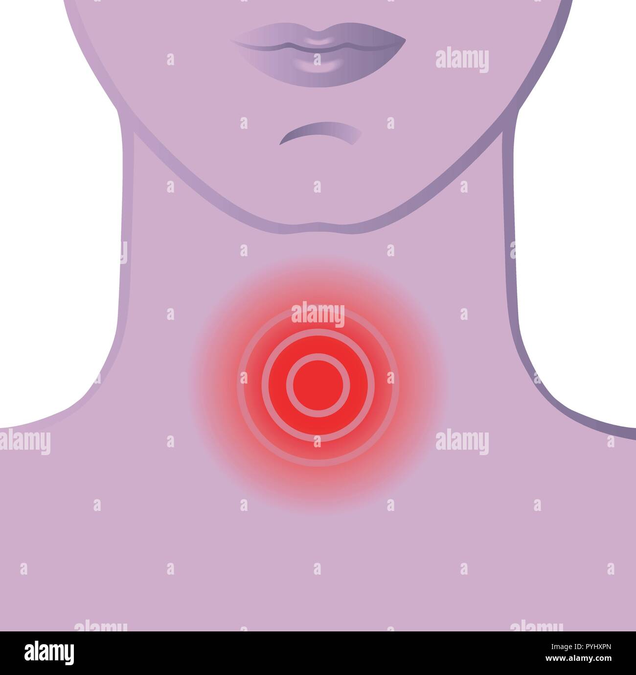 Illustration médicale des symptômes de maux de gorge Illustration de Vecteur