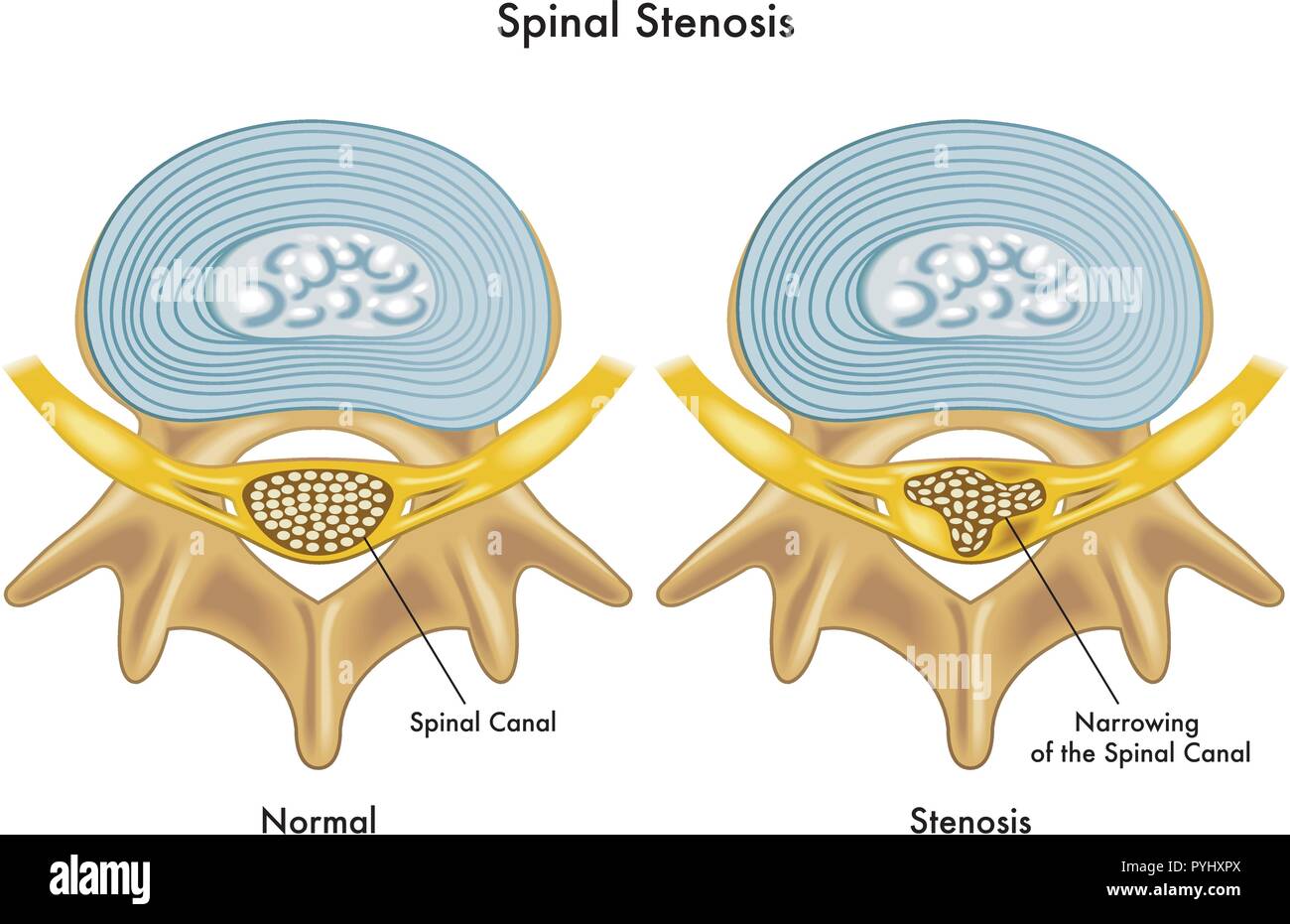 Illustration des effets médicaux de la sténose spinale Illustration de Vecteur