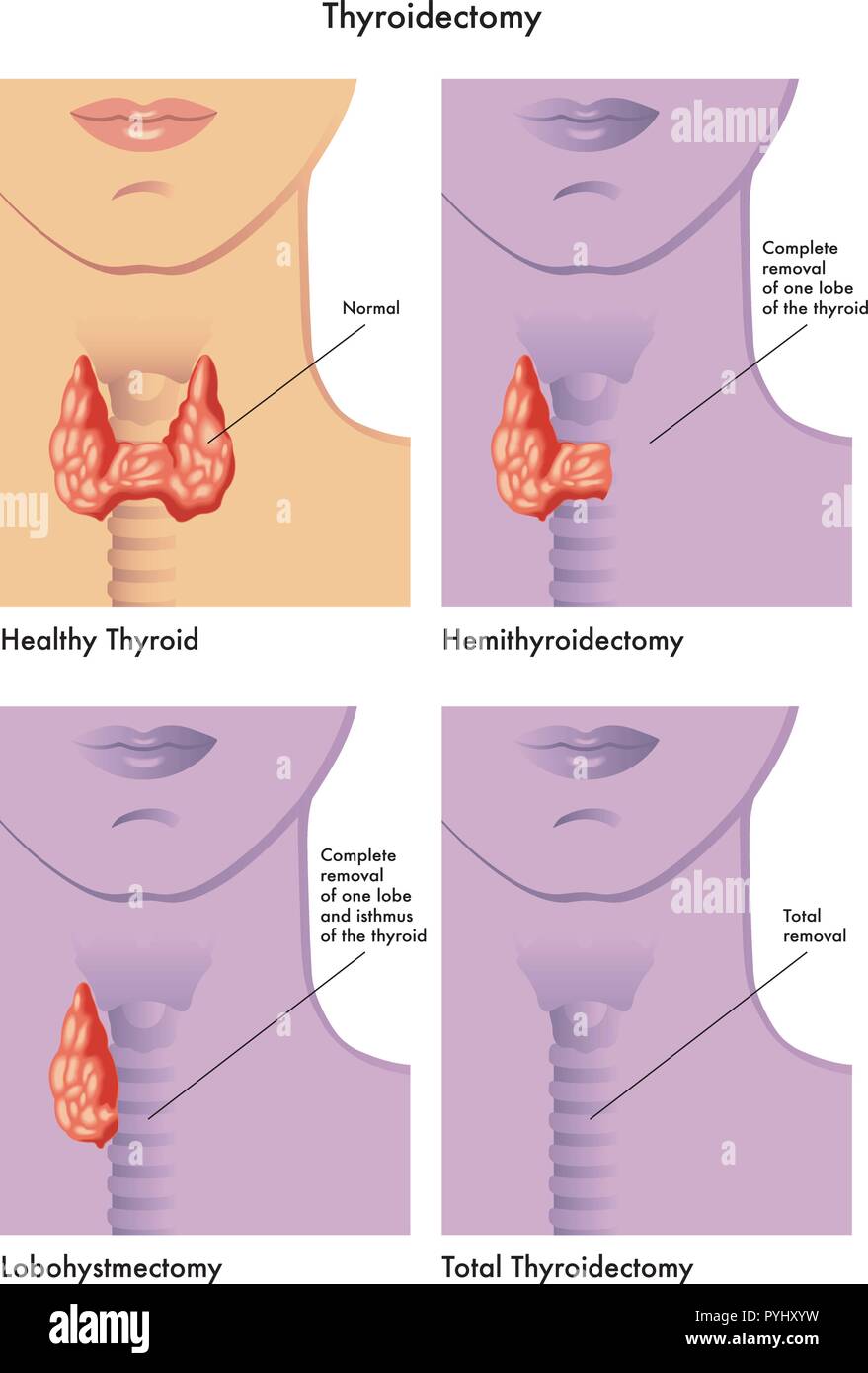 Illustration médicale des différents types de la thyroïdectomie Illustration de Vecteur