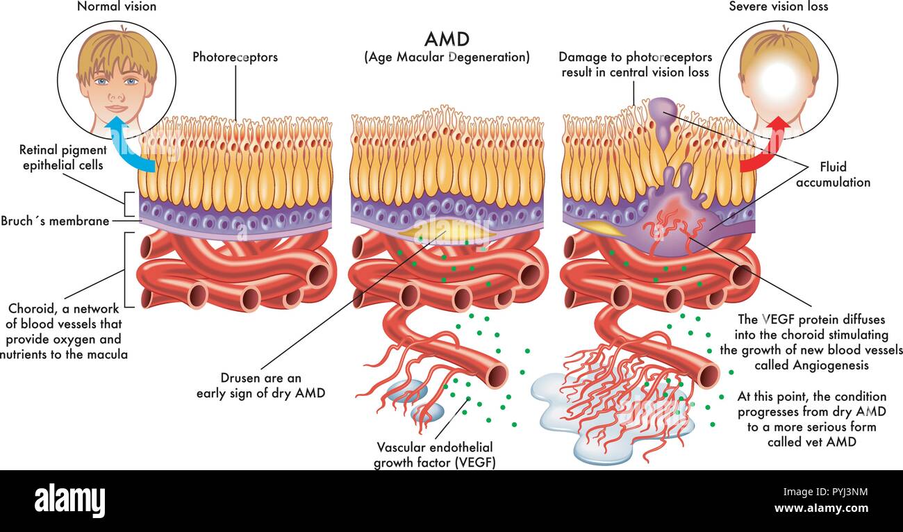 Une illustration vectorielle médicale des symptômes de la DMLA ou dégénérescence maculaire liée à l'âge. Illustration de Vecteur