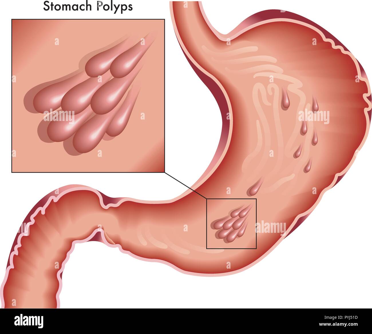 Illustrated Medical dessin de polypes de l'estomac avec Illustration de Vecteur