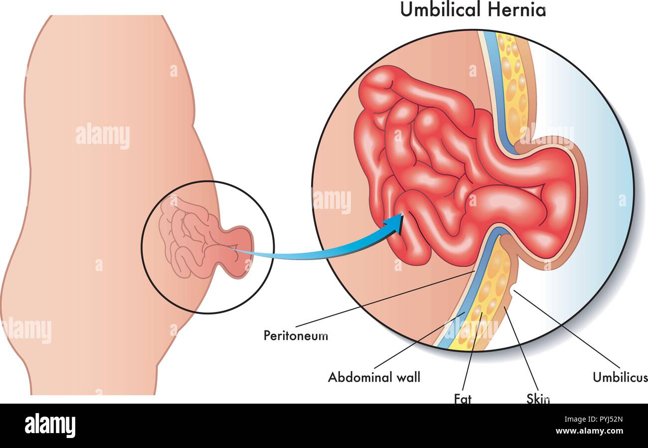 Hernie ombilicale Banque de photographies et d'images à haute résolution -  Alamy