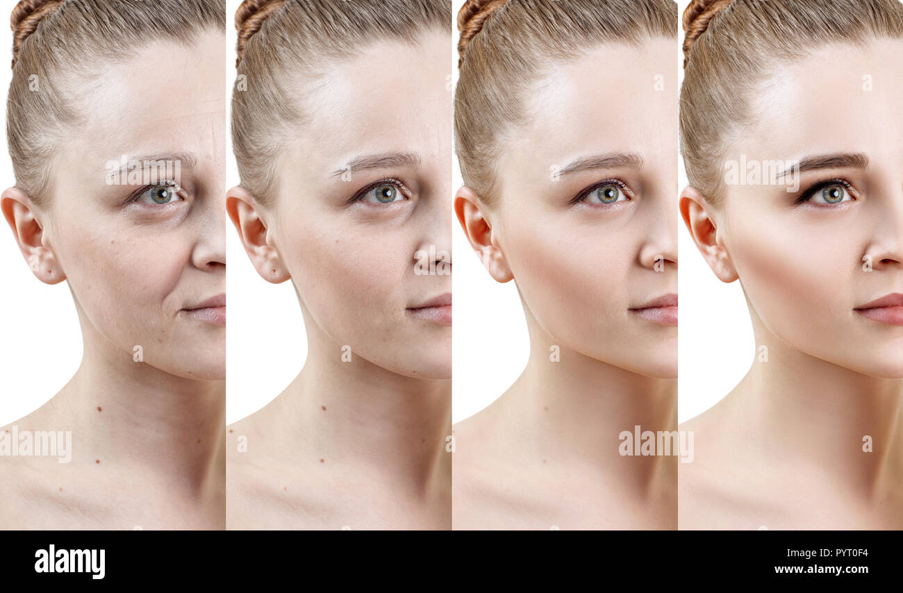 Femme avec la phase de rajeunissement de la peau avant et après le traitement. Banque D'Images