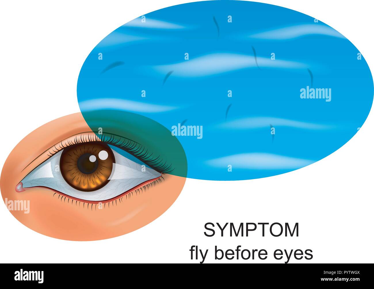 Vector illustration d'une mouche devant les yeux. symptôme de maladies de l'œil Illustration de Vecteur