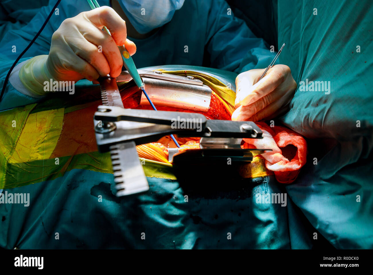 Le chirurgien fait une opération chirurgien en salle d'opération avec masque de sang Banque D'Images