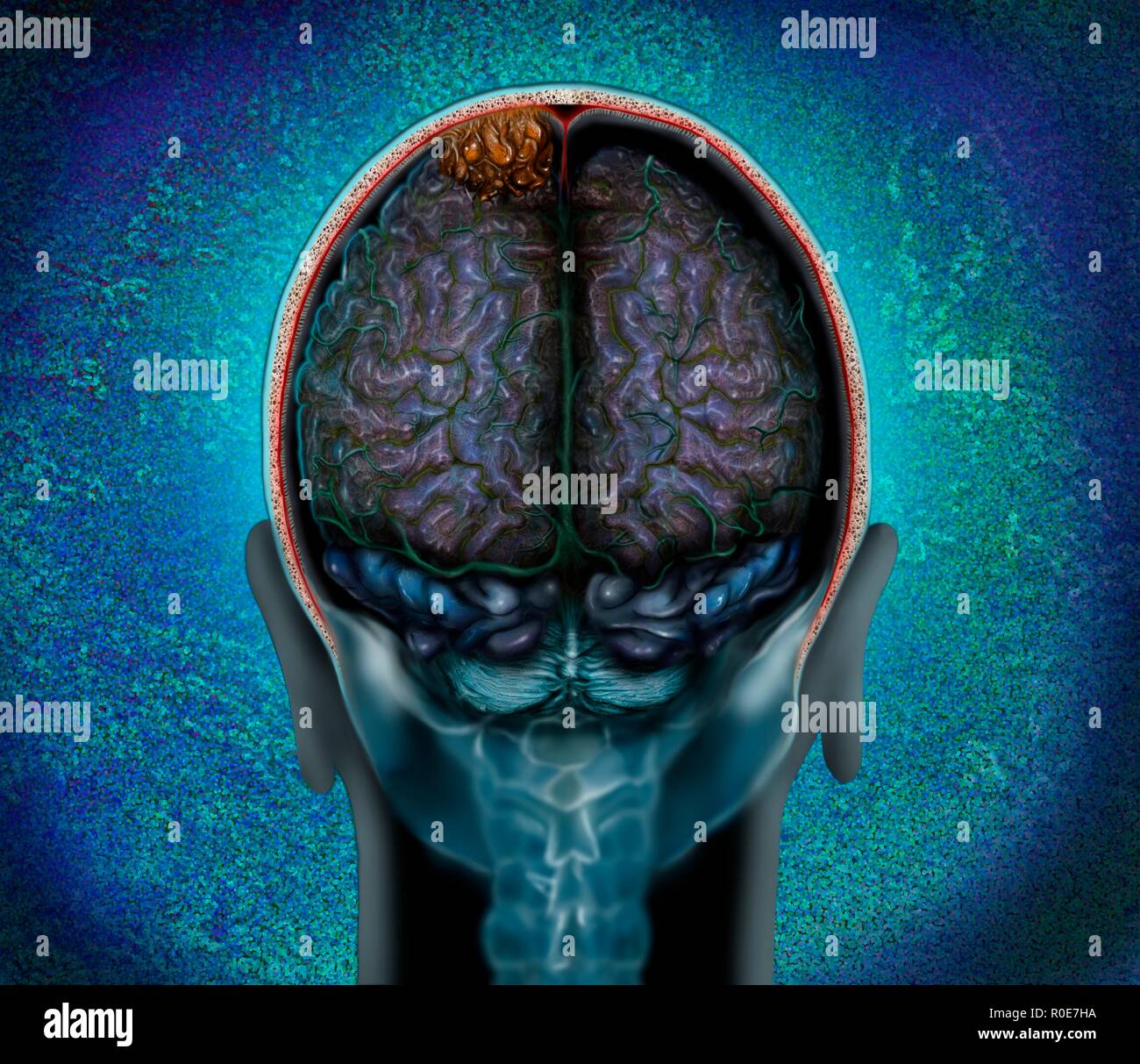 Irm Anormal Du Cerveau Banque De Photographies Et D images Haute 