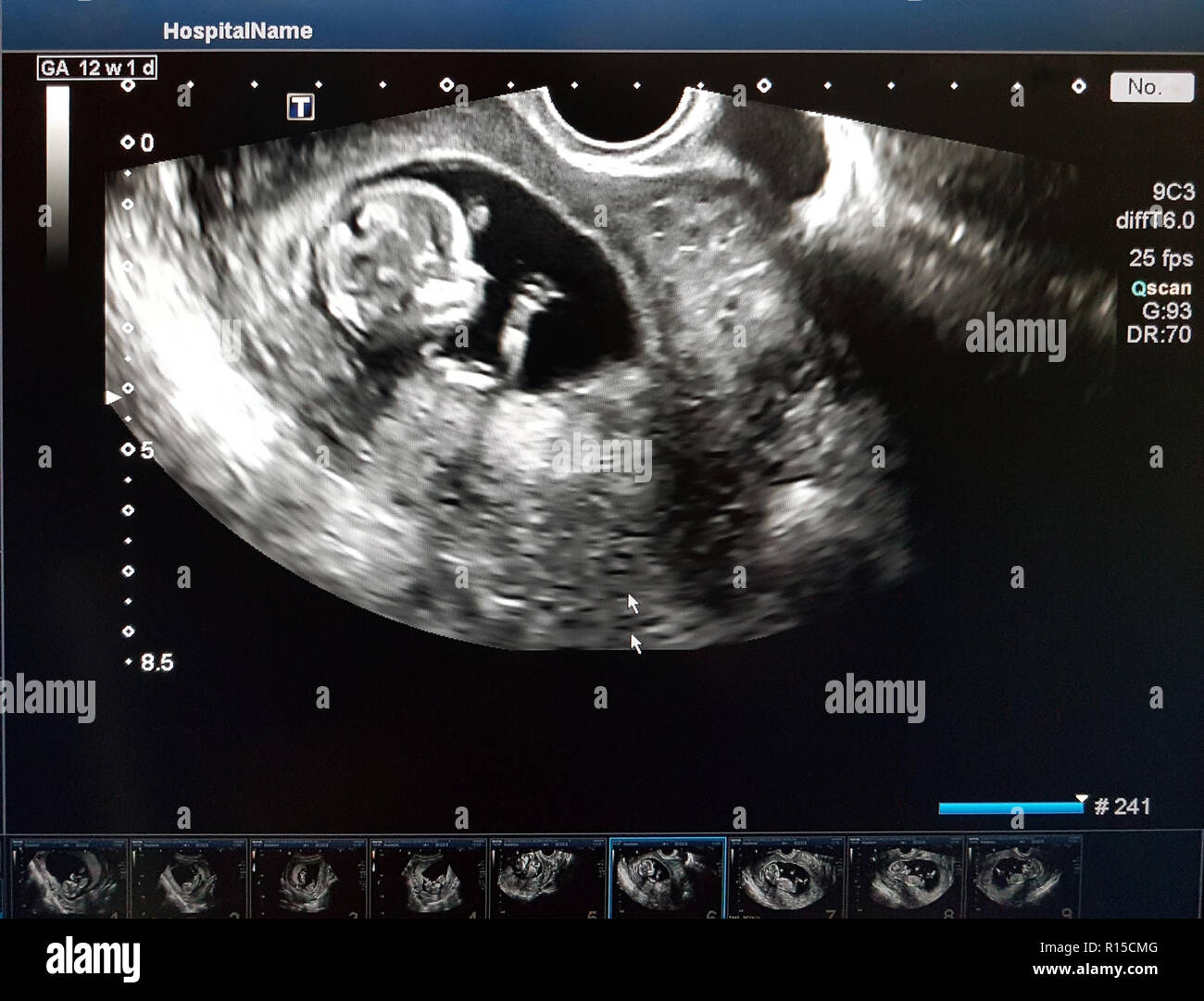 Photos De L Enfant Dans La 12 Semaine De Grossesse Procedure D Echographie Le Depistage Dans Le Premier Trimestre Photo Stock Alamy Photos De L Enfant Dans La 12 Semaine De Grossesse Procedure D Echographie Le Depistage Dans Le Premier Trimestre Photo Stock Alamy