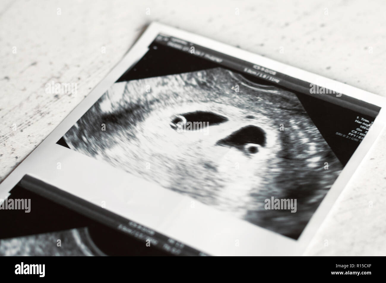 Aperçu des twins sur l'échographie au stade d'embryons. Échographie de grossesse multiple dans la quatrième semaine. Selective focus Banque D'Images