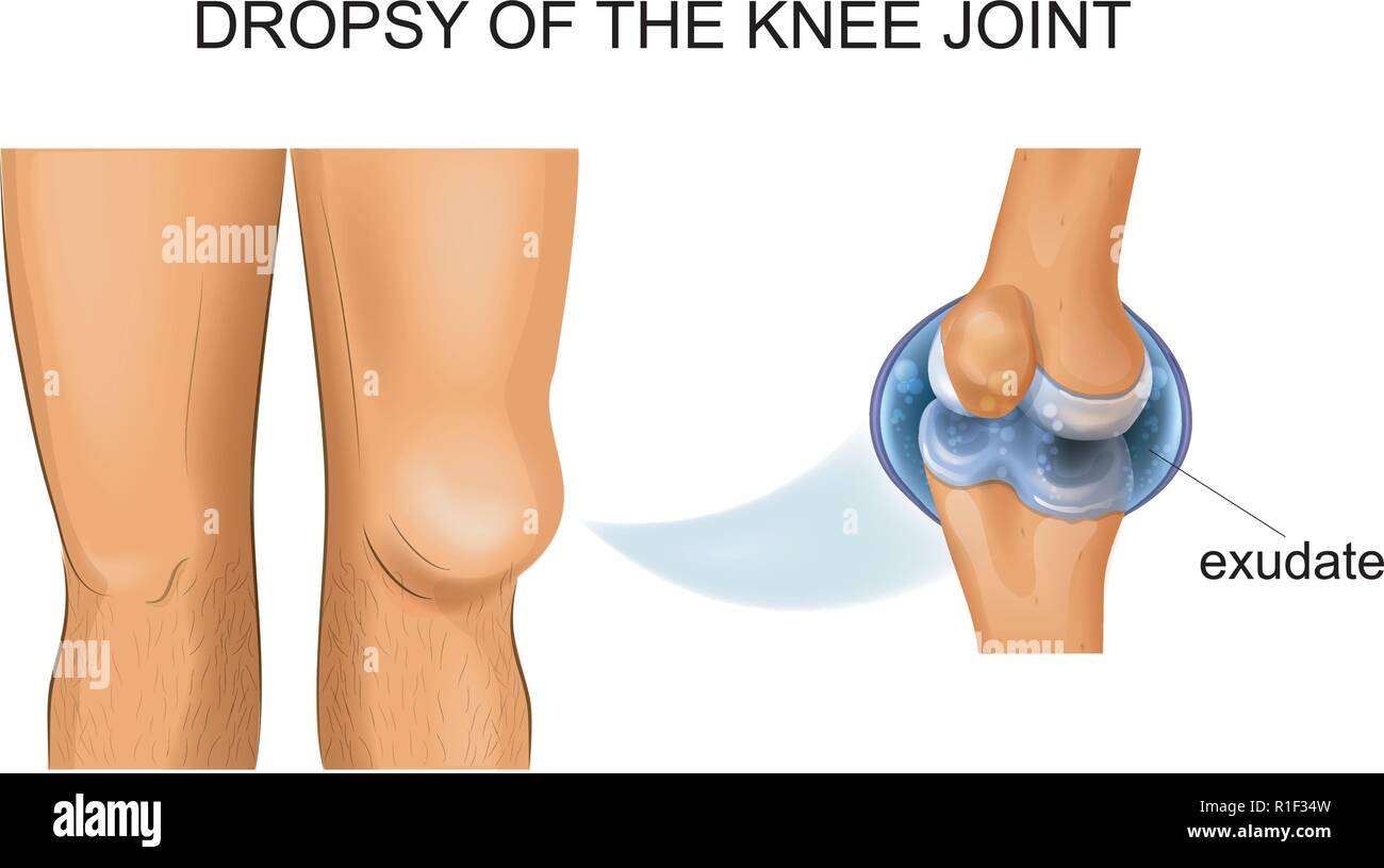 Vector illustration d'hydrarthrosis articulaire du genou, l'hydropisie Illustration de Vecteur