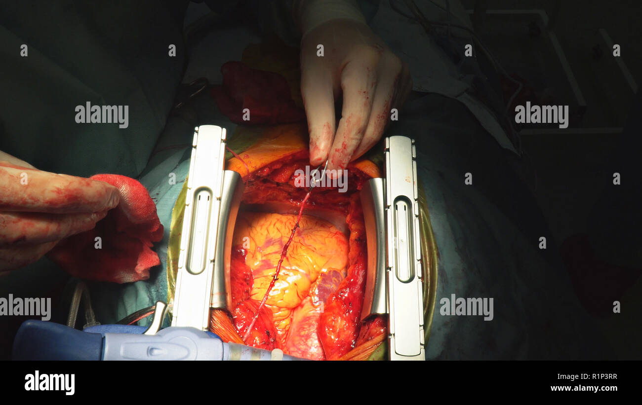 La chirurgie cardiaque. La chirurgie à cœur ouvert grande veine saphène suture Banque D'Images