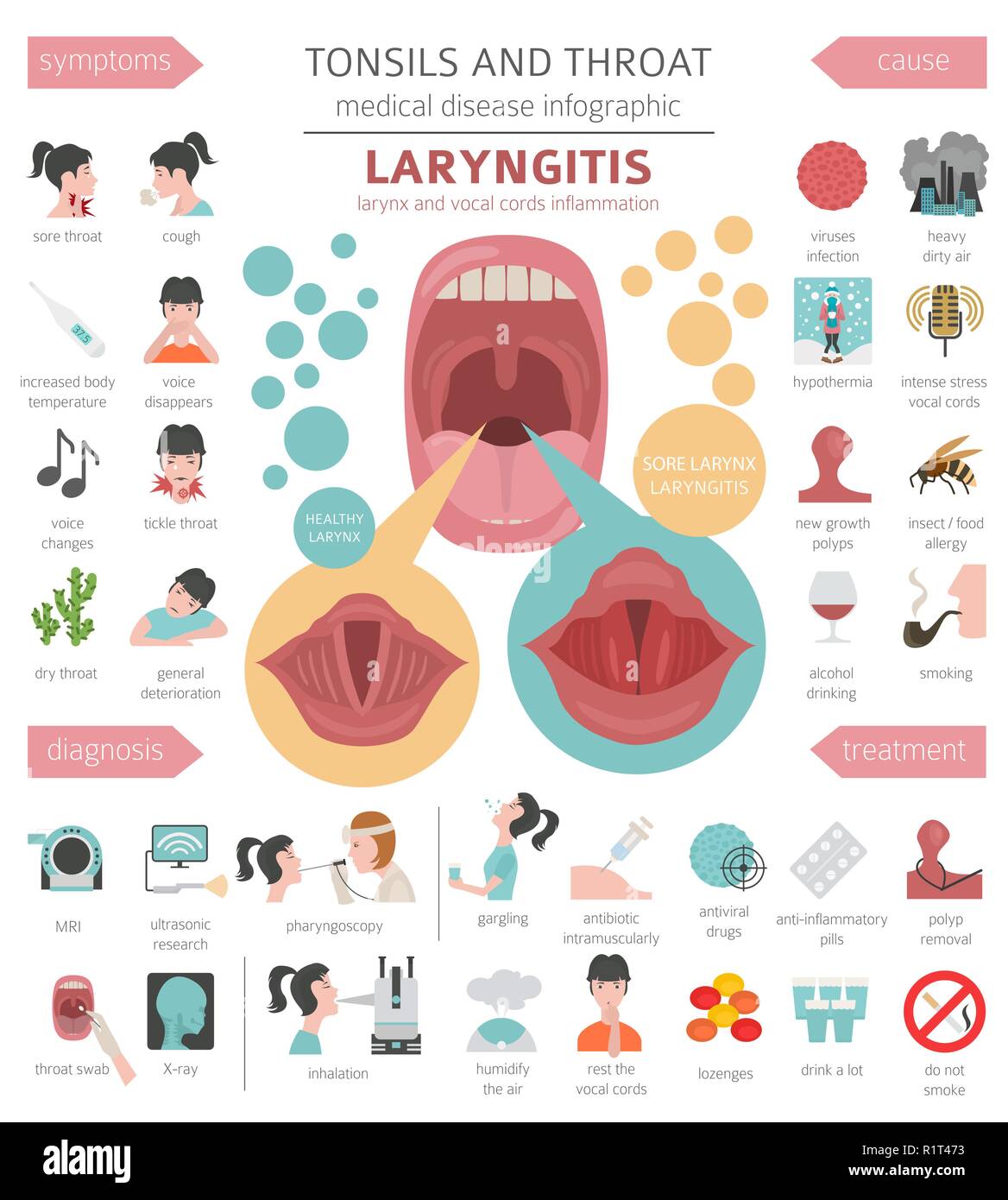 Amygdales et de la gorge. Les symptômes de la laryngite, l'icône de traitement défini. Conception infographique médical. Vector illustration Illustration de Vecteur