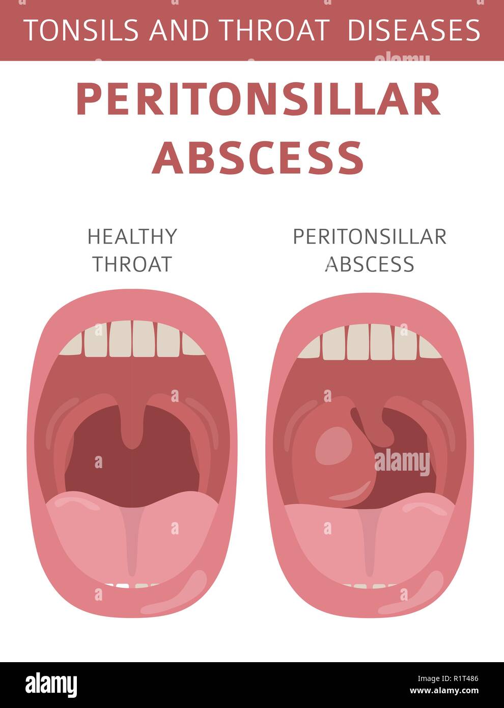 Amygdales Et De La Gorge Abces Periamygdalien Symptomes Traitement Icon Set Conception Infographique Medical Vector Illustration Image Vectorielle Stock Alamy