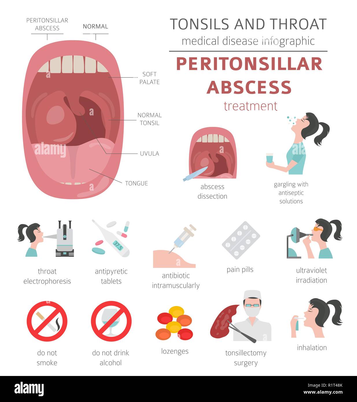 Amygdales et de la gorge. Abcès périamygdalien symptômes, traitement icon set. Conception infographique médical. Vector illustration Illustration de Vecteur