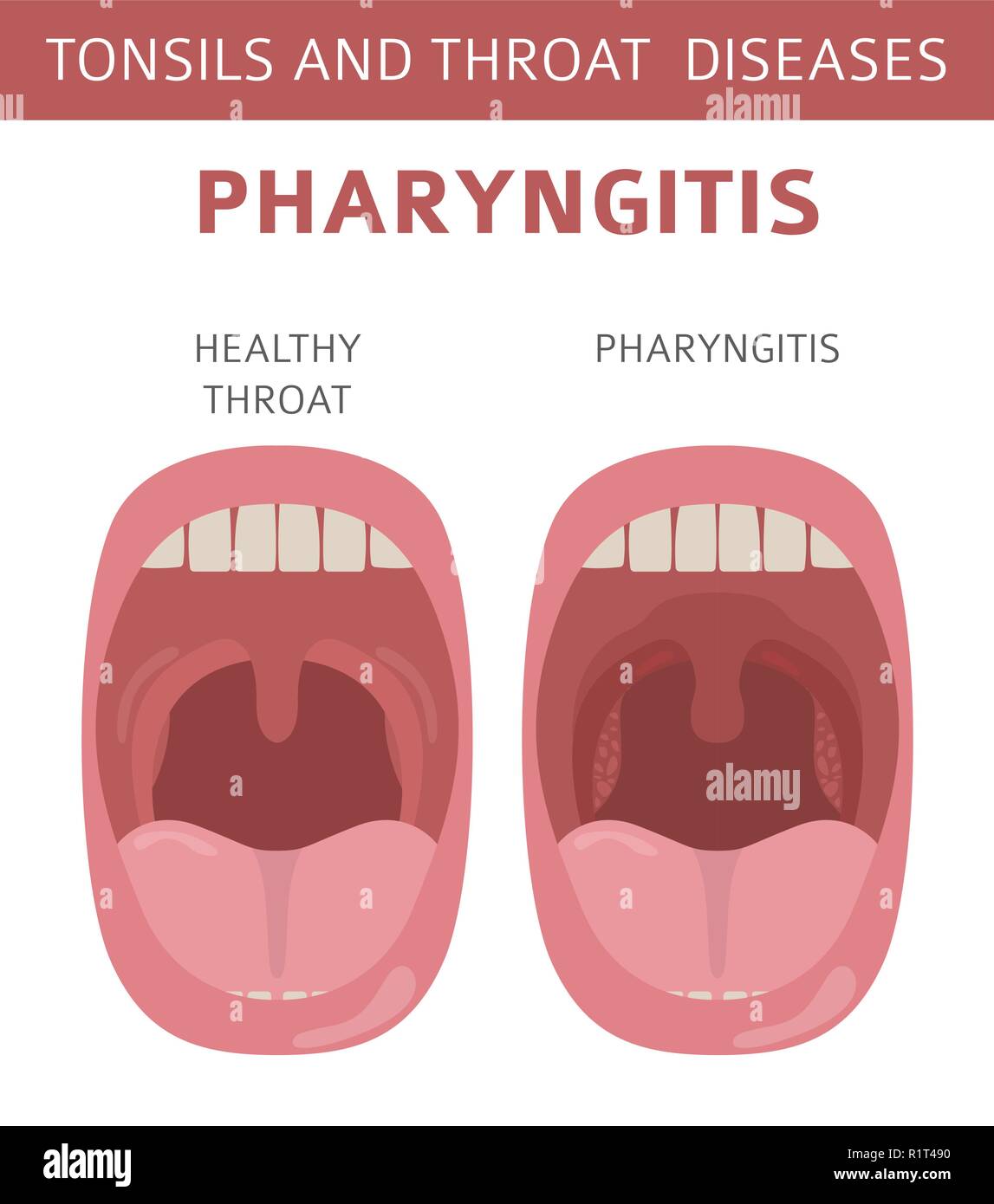 Amygdales et de la gorge. Les symptômes de la pharyngite, icône de traitement défini. Conception infographique médical. Vector illustration Illustration de Vecteur