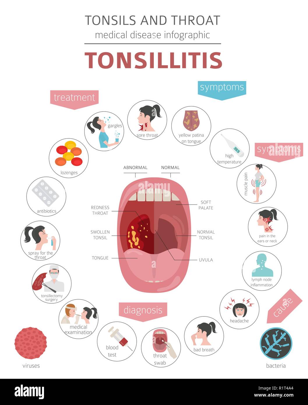 Amygdales et de la gorge. Les symptômes de l'amygdalite, icône de traitement défini. Conception infographique médical. Vector illustration Illustration de Vecteur