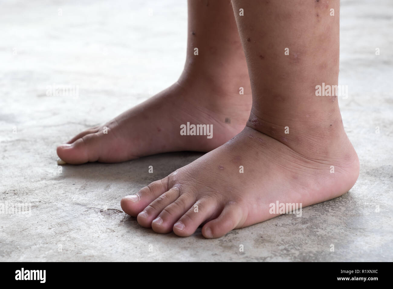 La dermatite prurigineuse bébé atopique pied. Close up.plaies infectées plaie ouverte à la jambe gauche. Banque D'Images