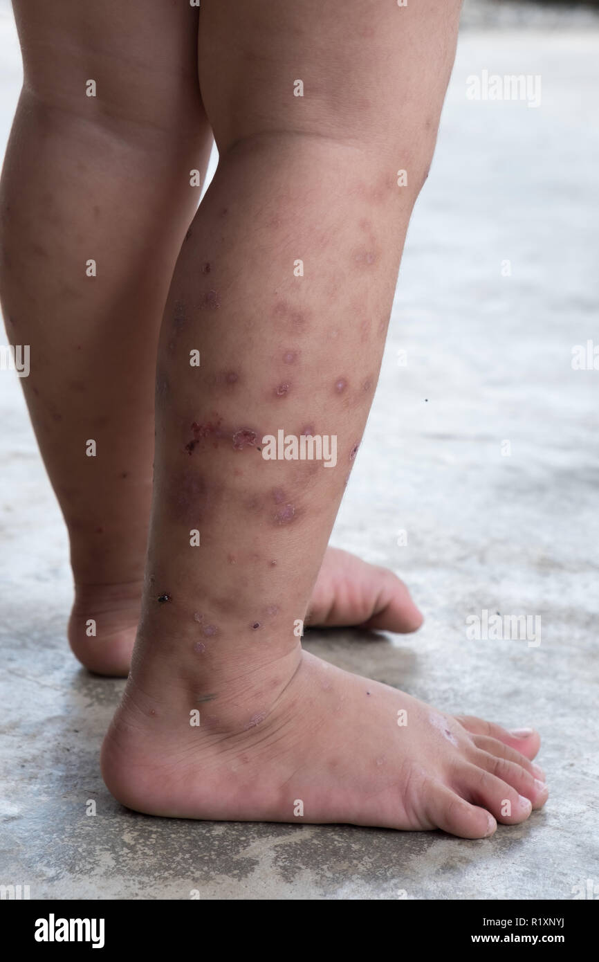 La dermatite prurigineuse bébé atopique pied. Close up.plaies infectées plaie ouverte à la jambe gauche. Banque D'Images