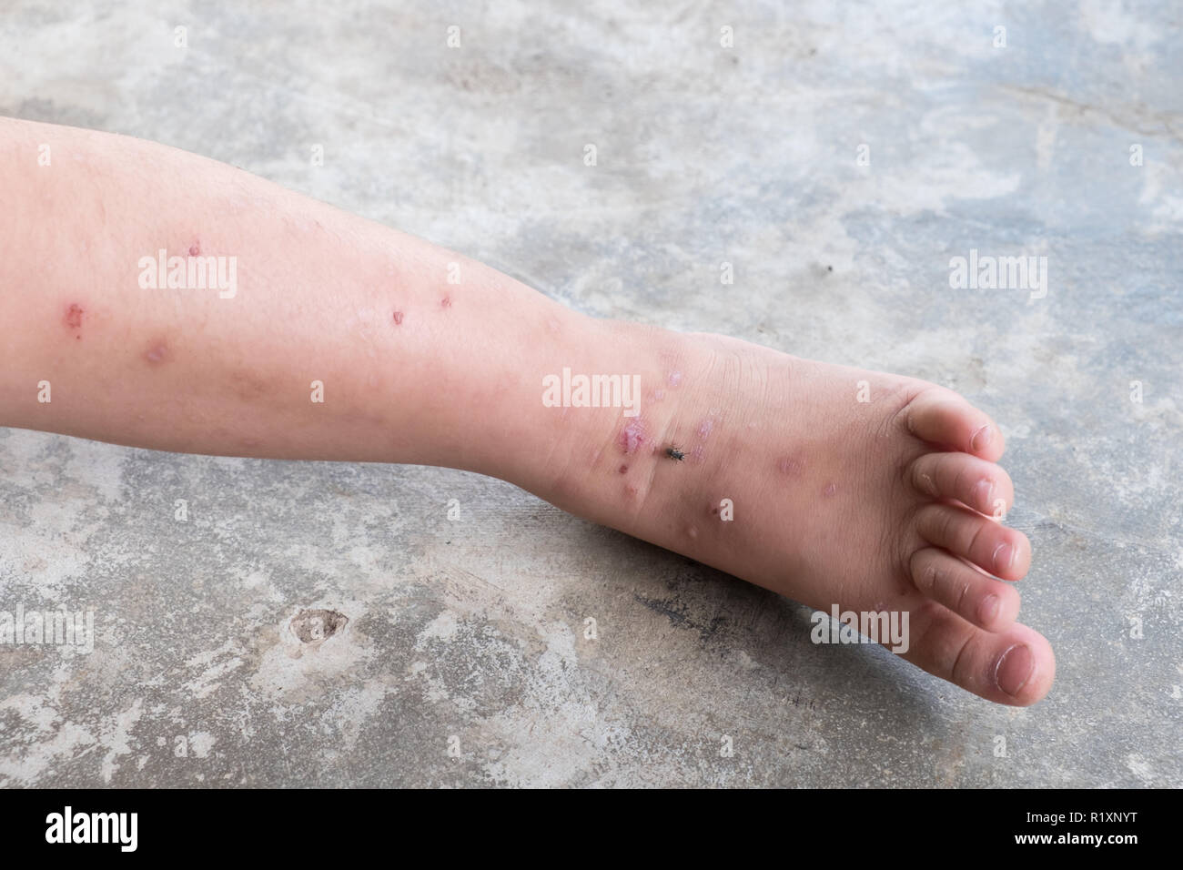 La dermatite prurigineuse bébé atopique pied. Close up.plaies infectées plaie ouverte à la jambe gauche. Banque D'Images