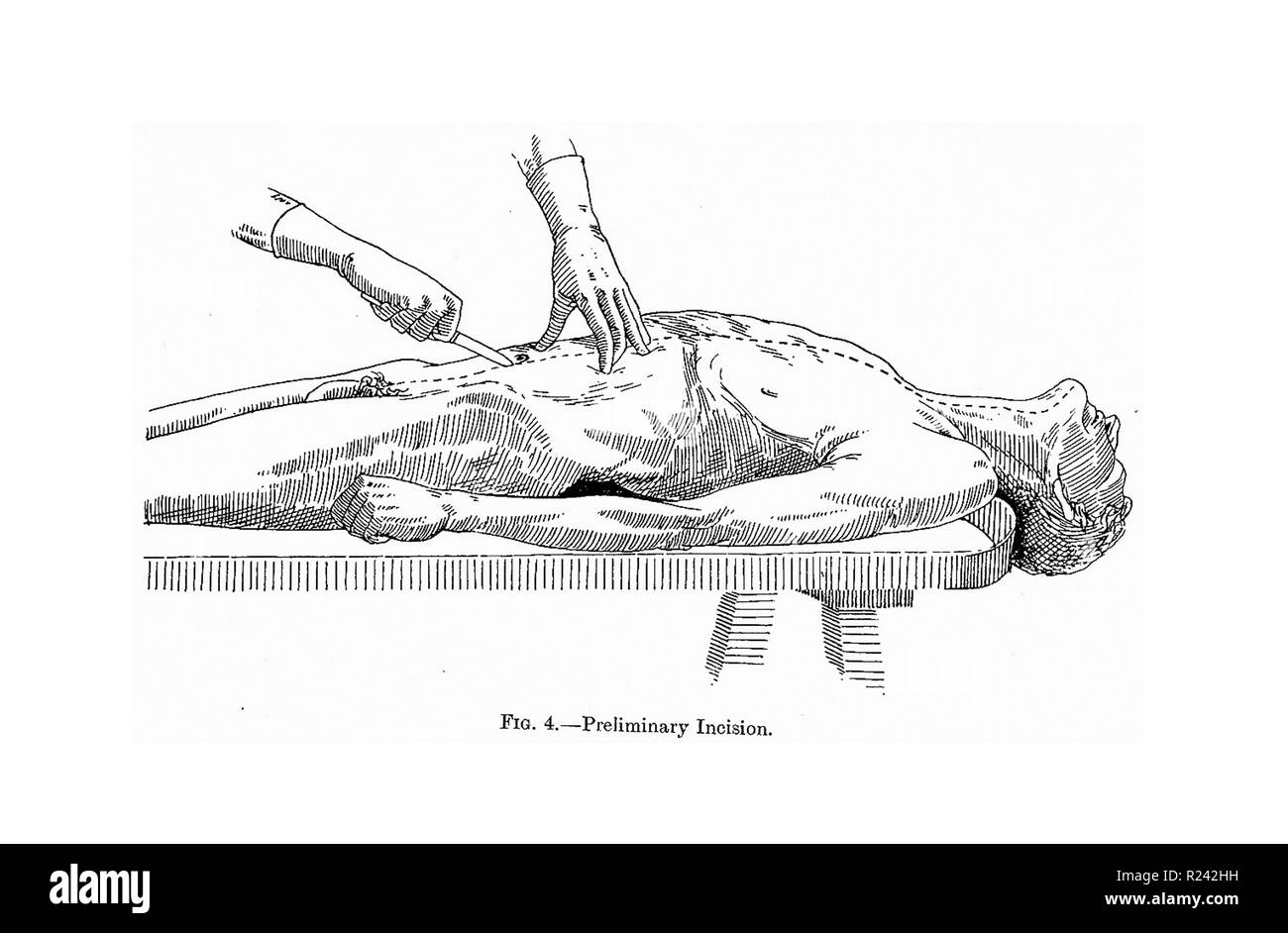 Incision préliminaire, 1910 un manuel d'Anatomie et morbide technique post-mortem Banque D'Images