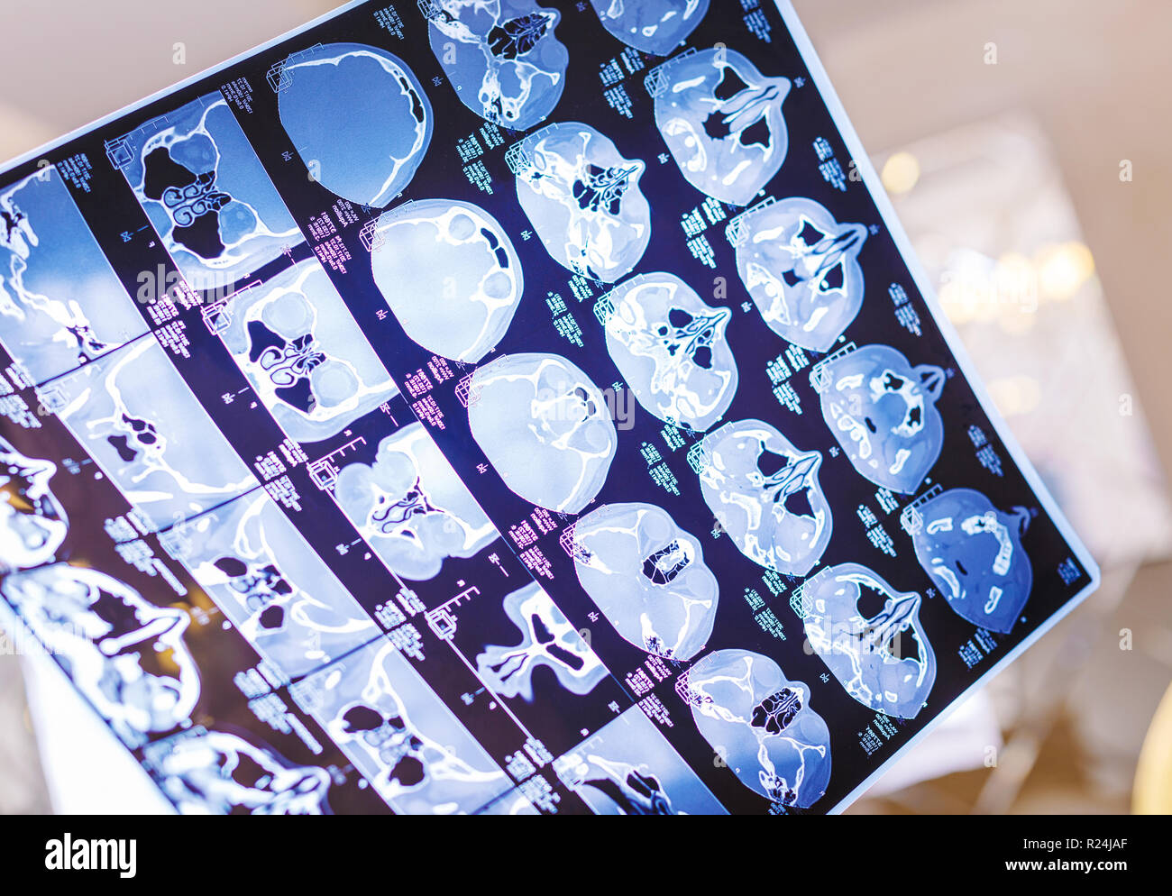 X-ray film de la tête la tomographie assistée par ordinateur Banque D'Images