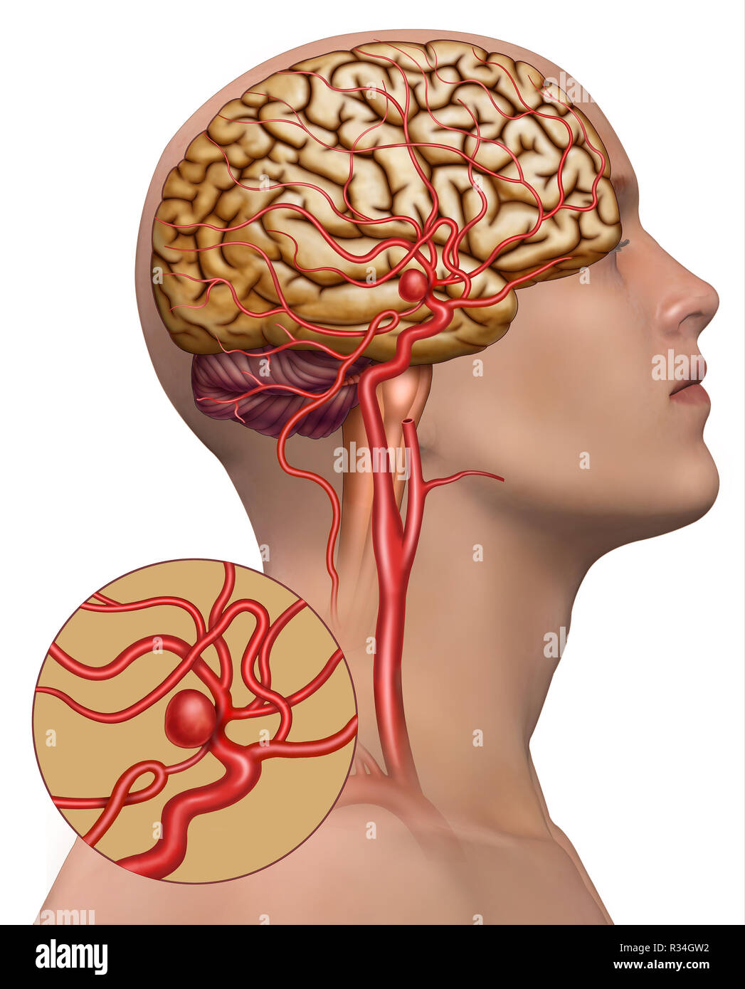 Aneurismas cerebrales Banque D'Images