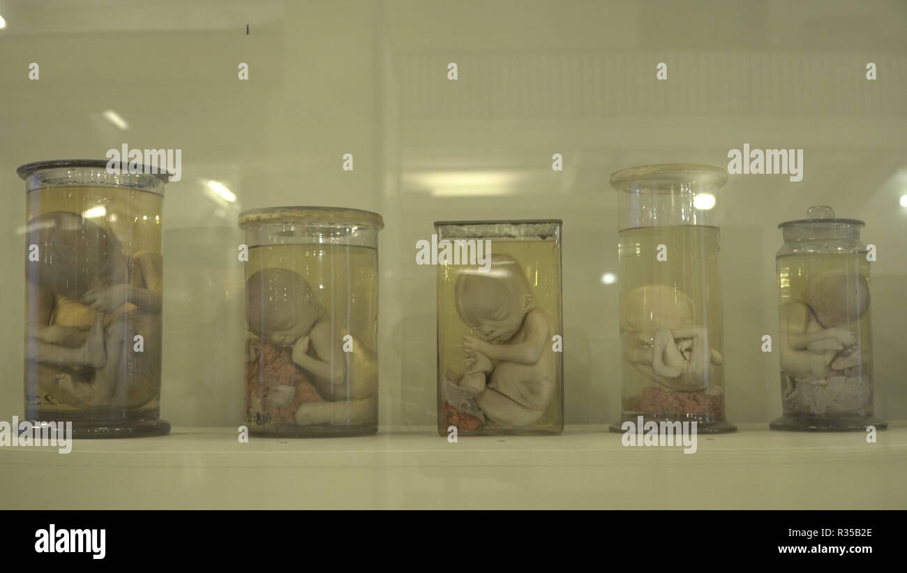 Des spécimens préservés anatomiques, la laideur, les anomalies. Les parties du corps conservés dans du formol pour l'étude scientifique par les scientifiques. Les éléments d'exposition en salle d'autopsie. Banque D'Images