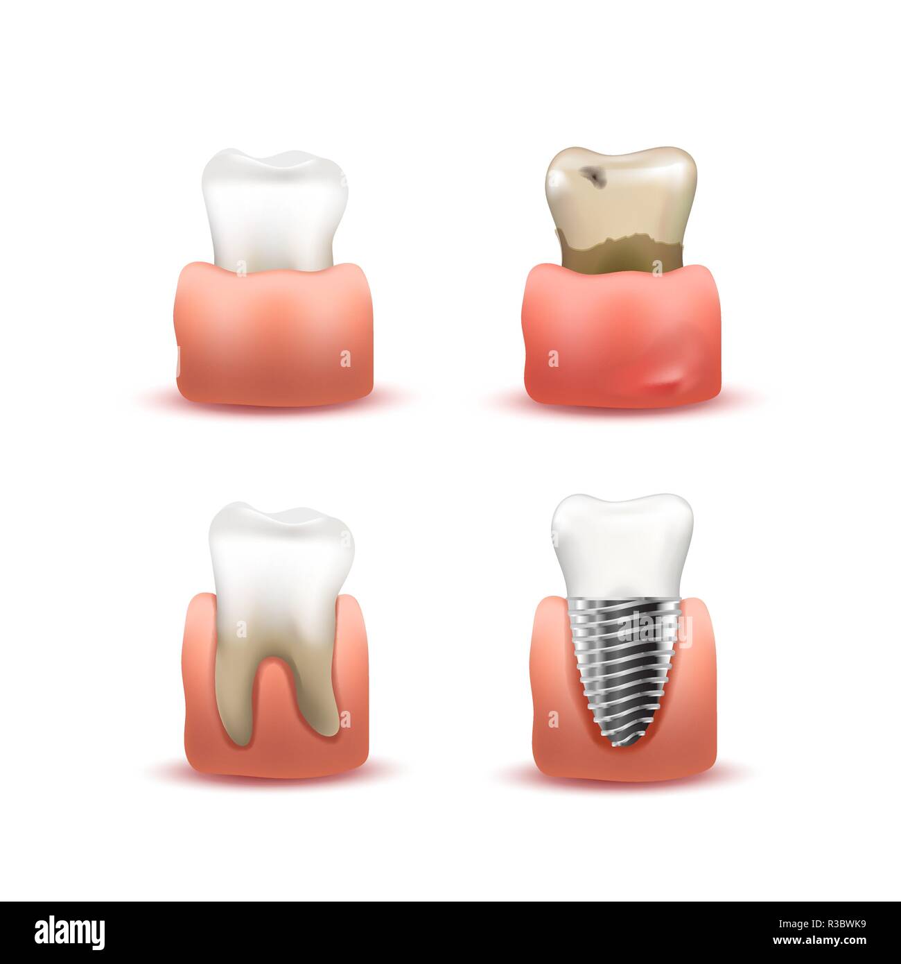 Ensemble de white en bonne santé, malades et pourris, implant artificiel en dents gencives on white Illustration de Vecteur