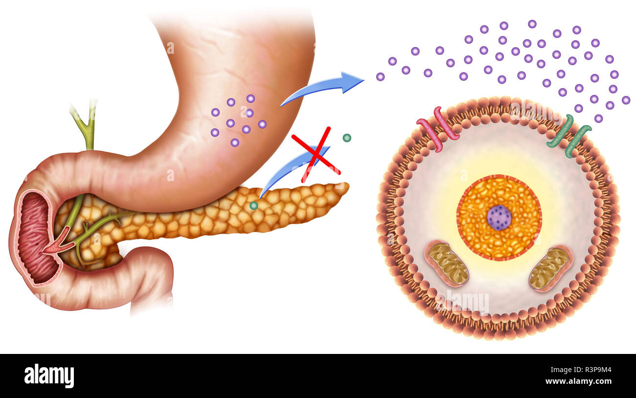 La personne atteinte de diabète de type 1, son corps ne produit pas d'insuline, le glucose s'accumule dans le sang et ne pénètre pas dans les cellules pour obtenir de l'énergie. Banque D'Images