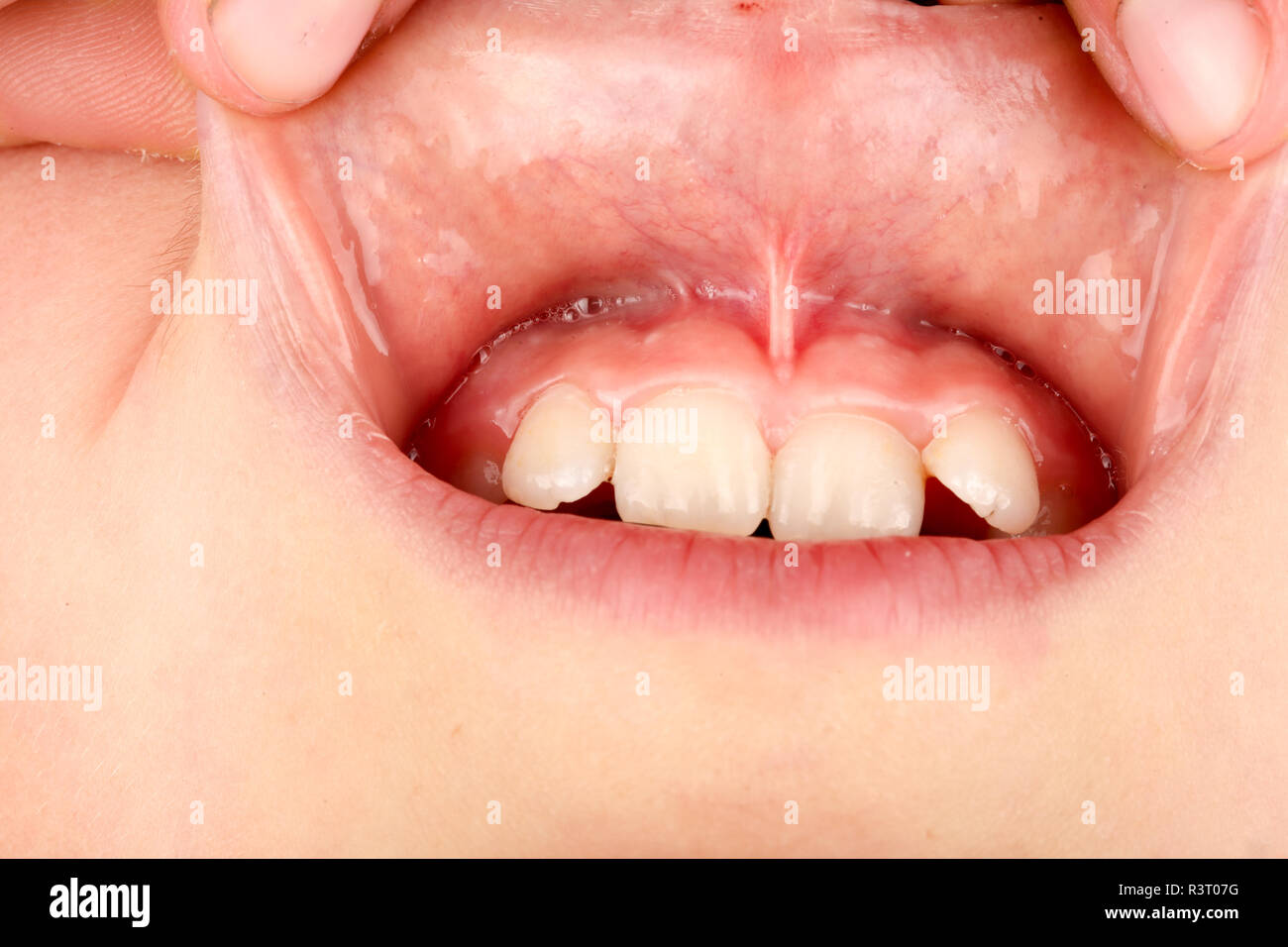 Le frein de la lèvre supérieure dans l'enfant close up Photo Stock - Alamy