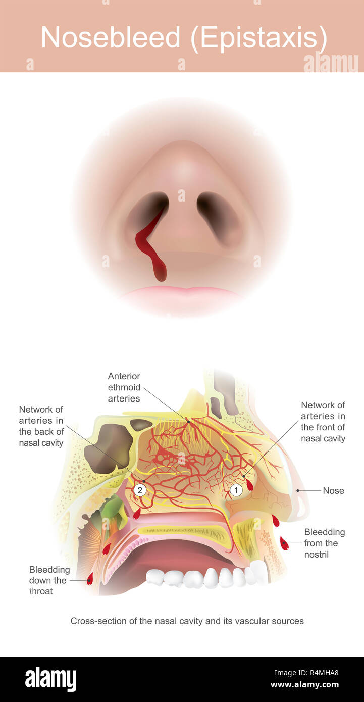 Des saignements du sinus est provoquée par la déchirure des artères à l'intérieur de la cavité nasale. Banque D'Images