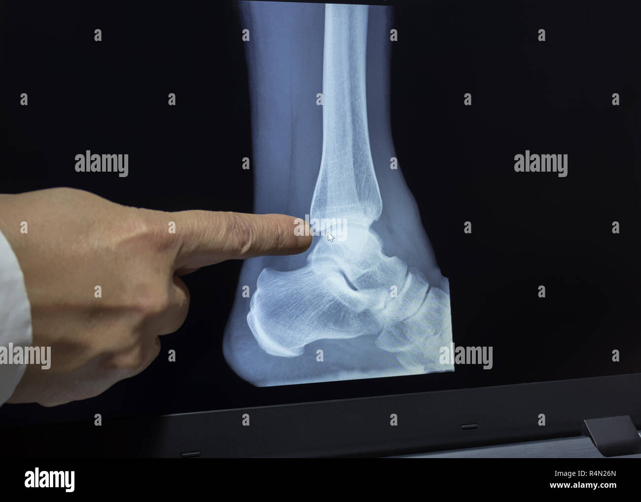 Une radiographie d'un talon avec une main de médecin indiquant une fracture sorcière Banque D'Images