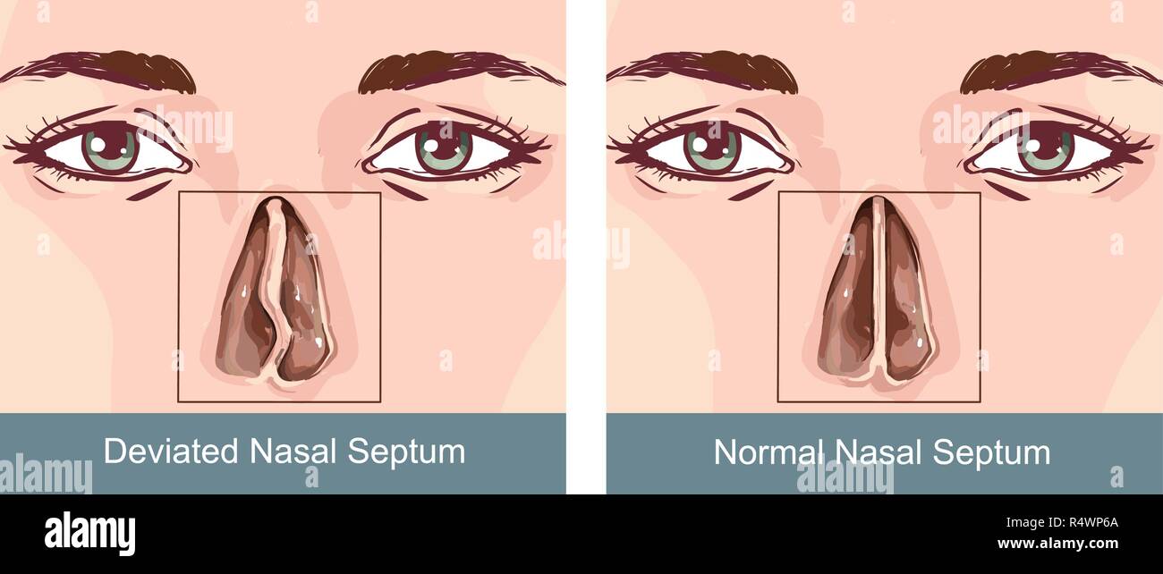 Déviation de la cloison nasale traitemen Illustration de Vecteur