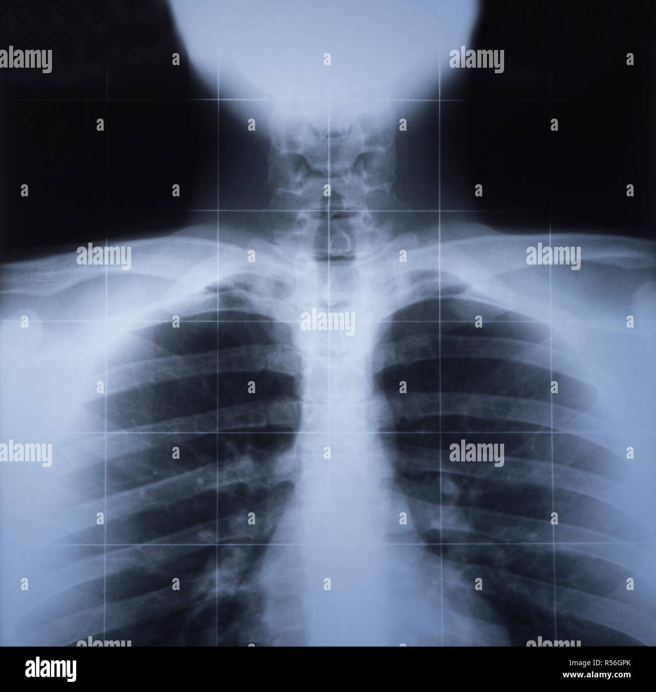 X Ray de droit des droits de l'thorax Banque D'Images