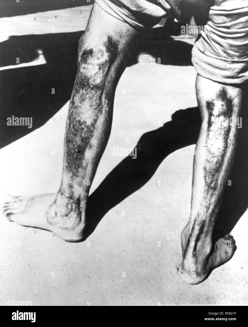 Effets des radiations sur l'homme et de chaleur, le Japon ca. 1945 Banque D'Images