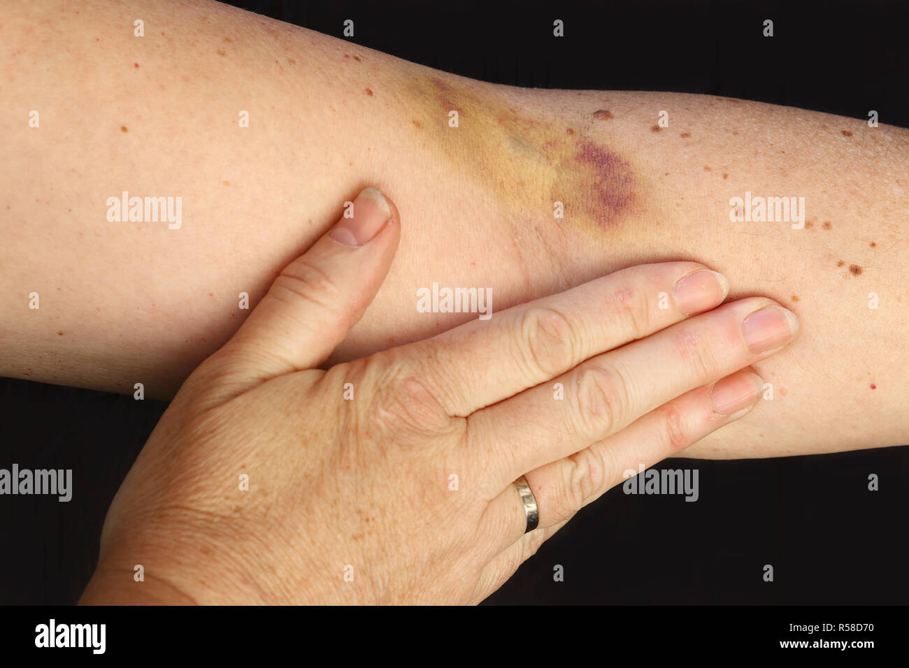 Un hématome sur le bras d'une femme. un gros bleu sur le bras d'une femme  Photo Stock - Alamy