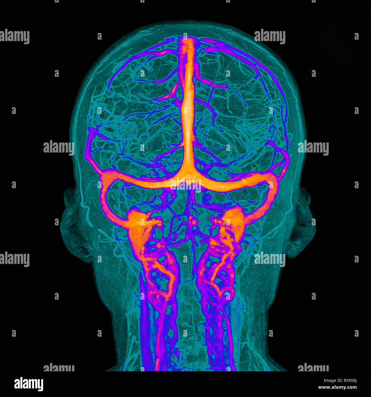 Vaisseaux sanguins intracrâniens, Illustration basée sur la couleur de l'imagerie par résonance magnétique (IRM) d'un cerveau humain et de ses vaisseaux sanguins intracrâniens Banque D'Images