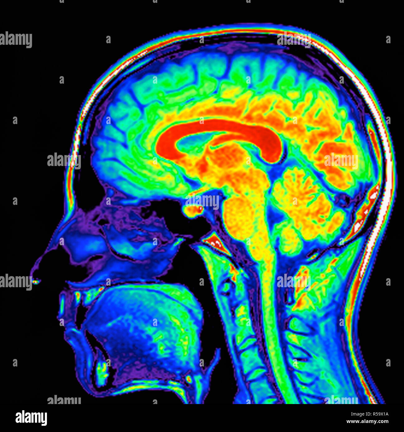 L'imagerie par résonance magnétique de couleur (IRM) d'une coupe sagittale dans la tête du patient montrant un cerveau humain en bonne santé. Banque D'Images