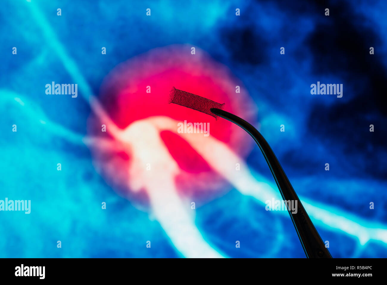 Stent pour traiter une obstruction des artères coronaires. Banque D'Images