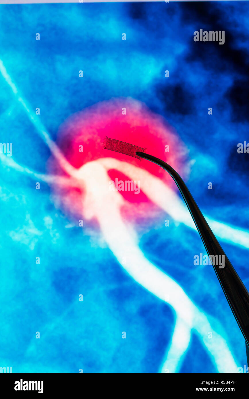Stent pour traiter une obstruction des artères coronaires. Banque D'Images