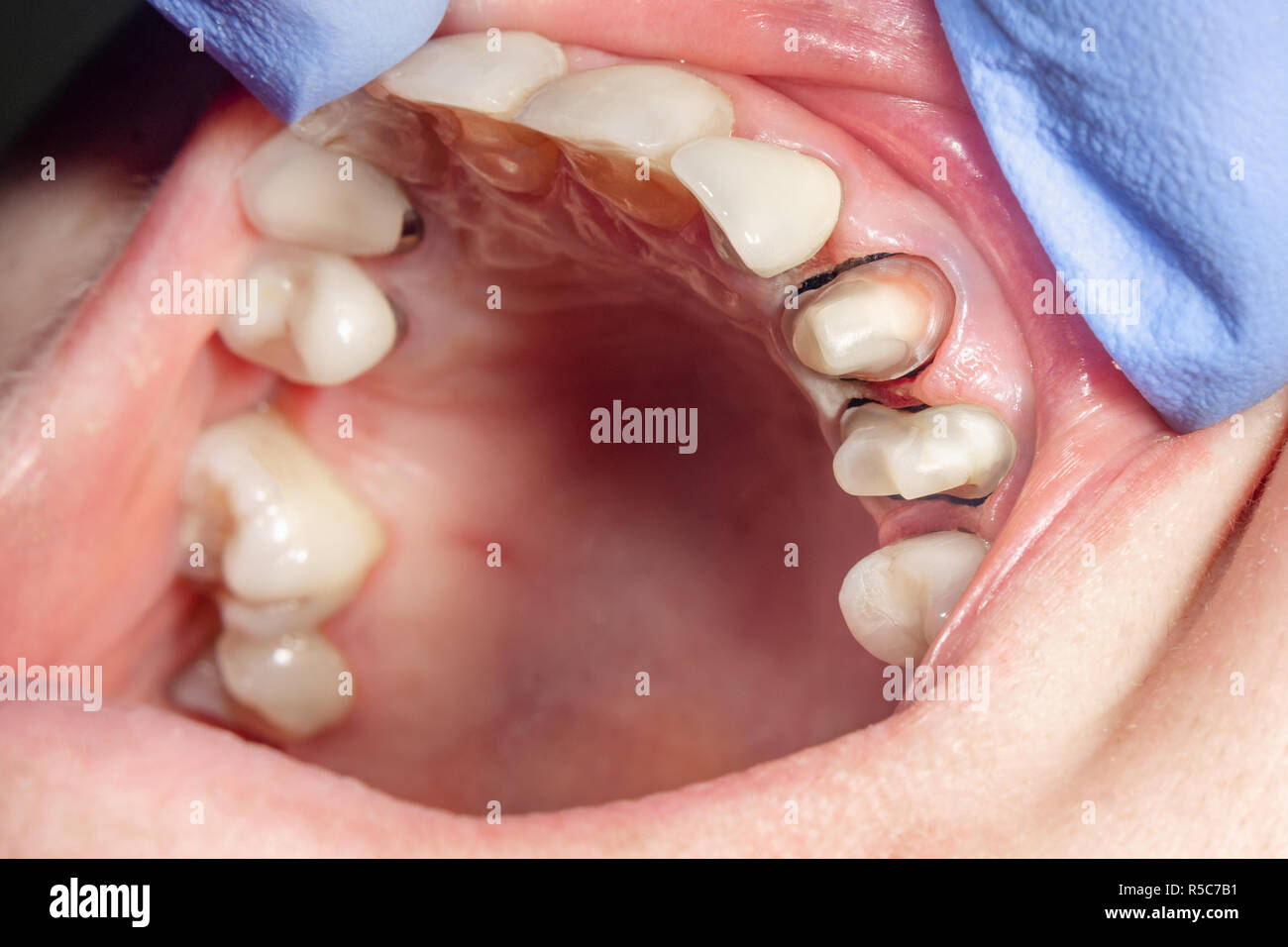 Broche dentaire close-up, la préparation de la dent pour la formulation de  la couronne en céramique. Le concept de la prothèse en dentisterie Photo  Stock - Alamy