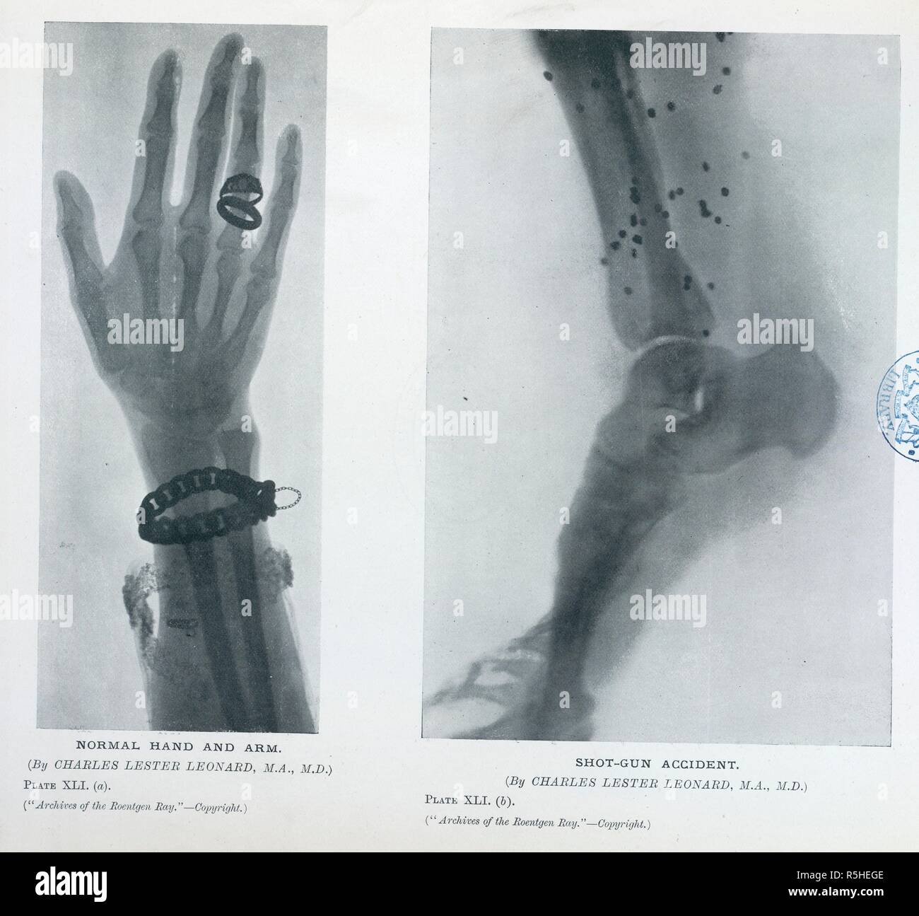 XLI la plaque. (A). Main normale et le bras. (Par Charles Lester Leonard, M.A, M.D.) XLI. (B). Fusil de chasse accident. Archives Le roentgen ray. Londres : Heinemann, 1897-1915. Source : 1640.750000 tome II 113. Banque D'Images